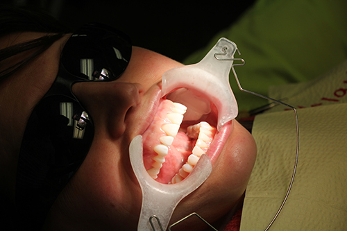 Adult Braces Adult Braces
