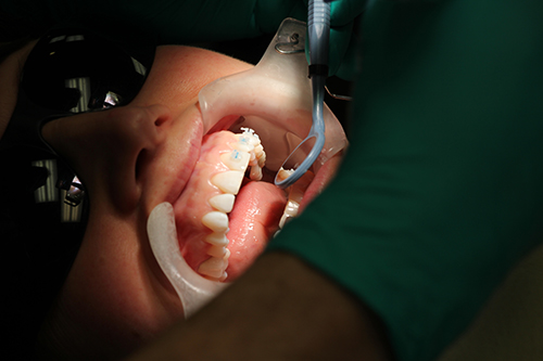 Adult Braces Adult Braces