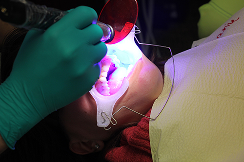 Adult Braces Adult Braces