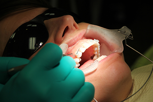 Adult Braces Adult Braces