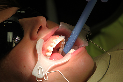 Adult Braces Adult Braces