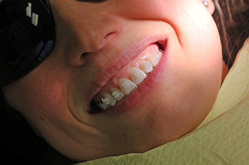 Adult Braces Adult Braces