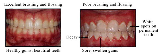 after braces after braces