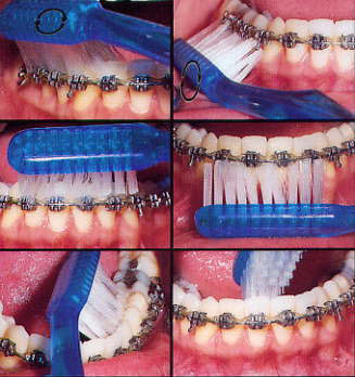 brushing lower brushing lower