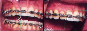 flossing flossing