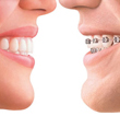 Invisalign Technology