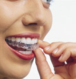 Invisalign Technology