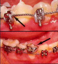 loose bracket loose bracket